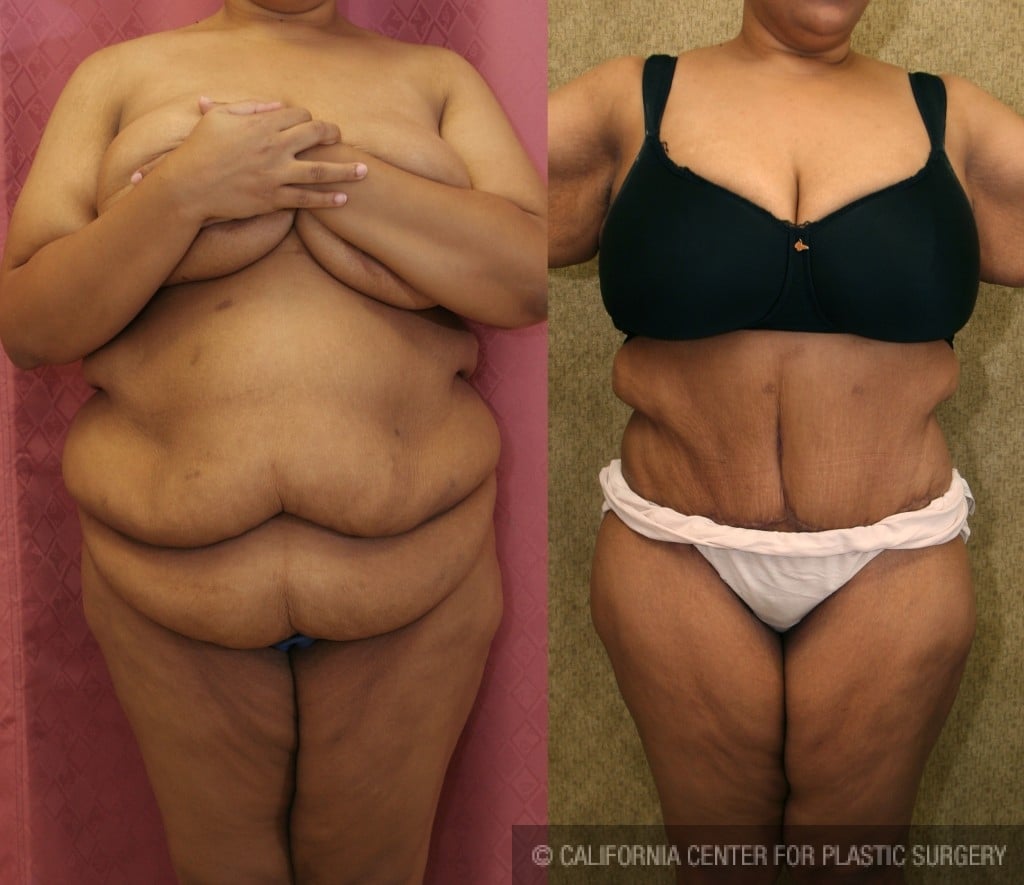 Tummy Tuck (Abdominoplasty) Plus Size Before & After Patient #5880