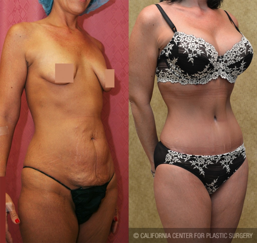 Tummy Tuck (Abdominoplasty) Small Size Before & After Patient #5732