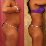 African American Tummy Tuck (Abdominoplasty) Before & After Patient #5933