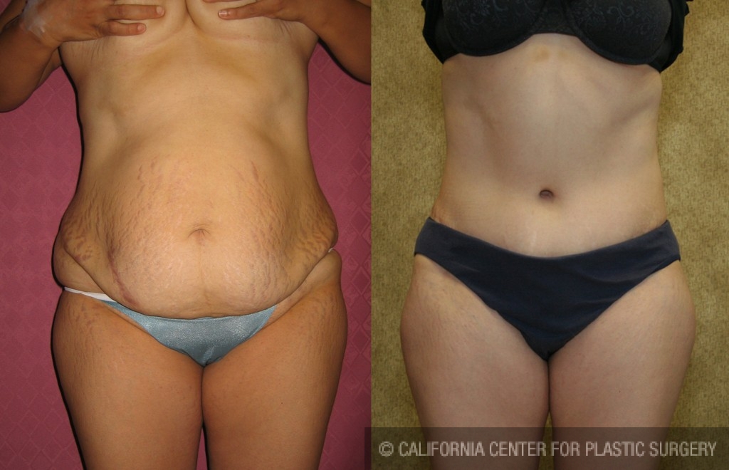 Tummy Tuck (Abdominoplasty) Medium Size Before & After Patient #5869