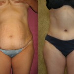 Tummy Tuck (Abdominoplasty) Medium Size Before & After Patient #5869