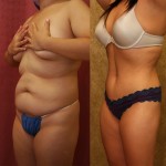 Tummy Tuck (Abdominoplasty) Medium Size Before & After Patient #5798