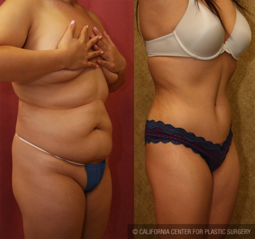 Tummy Tuck (Abdominoplasty) Medium Size Before & After Patient #5798