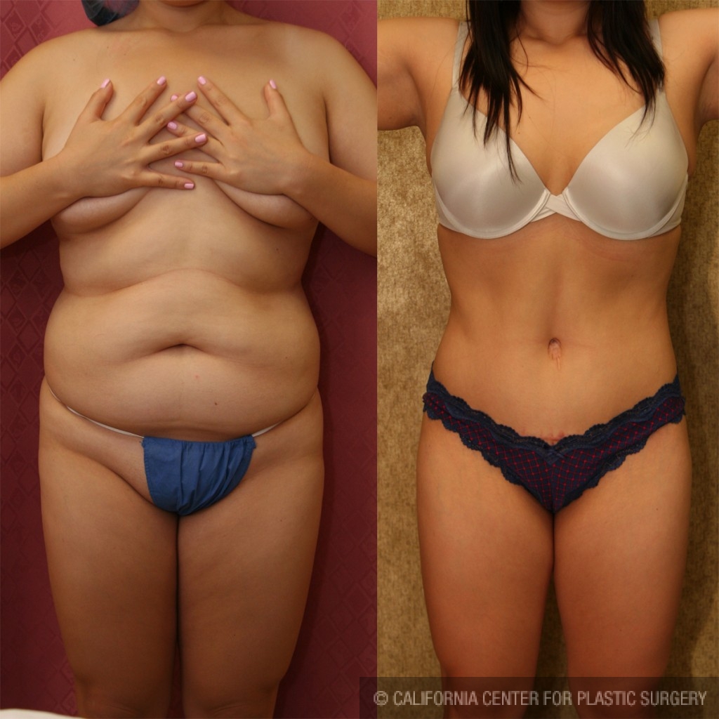 Tummy Tuck (Abdominoplasty) Medium Size Before & After Patient #5798