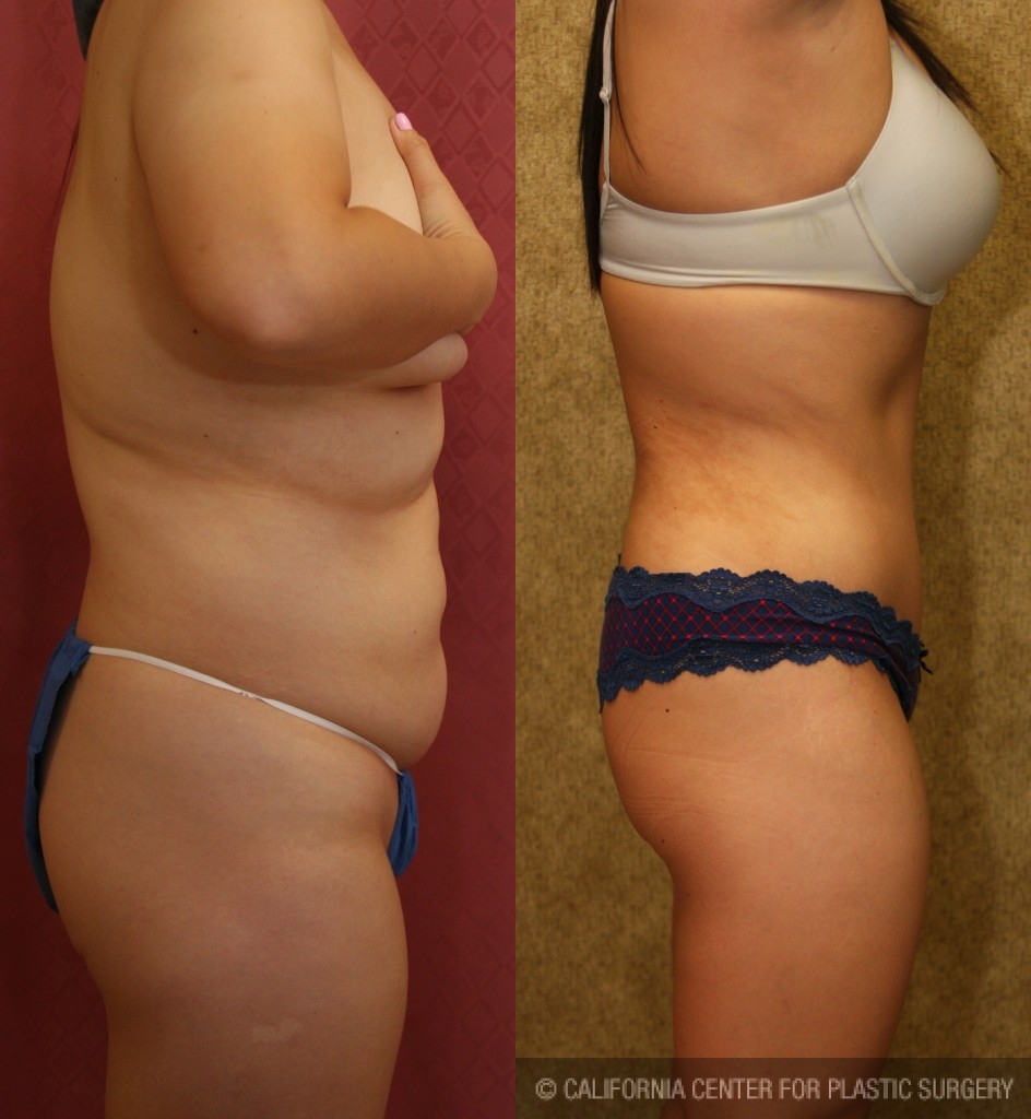 Tummy Tuck (Abdominoplasty) Medium Size Before & After Patient #5798