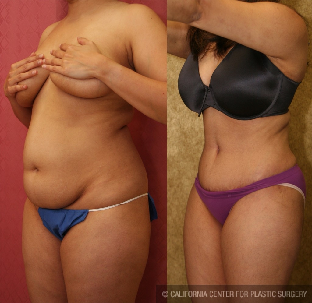 Tummy Tuck (Abdominoplasty) Small Size Before & After Patient #5745