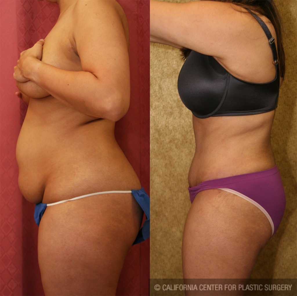 Tummy Tuck (Abdominoplasty) Small Size Before & After Patient #5745