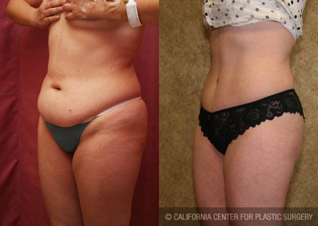 Patient #5737 Tummy Tuck (Abdominoplasty) Small Size Before and