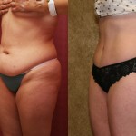 Tummy Tuck (Abdominoplasty) Small Size Before & After Patient #5737