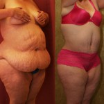 Tummy Tuck (Abdominoplasty) Plus Size Before & After Patient #5888