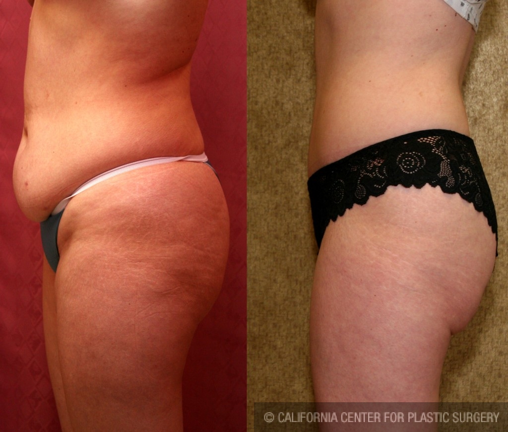 Patient #5737 Tummy Tuck (Abdominoplasty) Small Size Before and