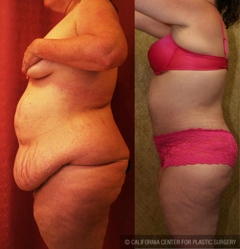 Tummy Tuck (Abdominoplasty) Plus Size Before & After Patient #5888