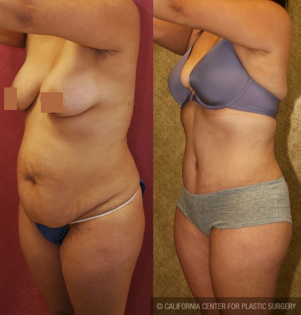 Tummy Tuck Medium Size Before & After Patient #5803