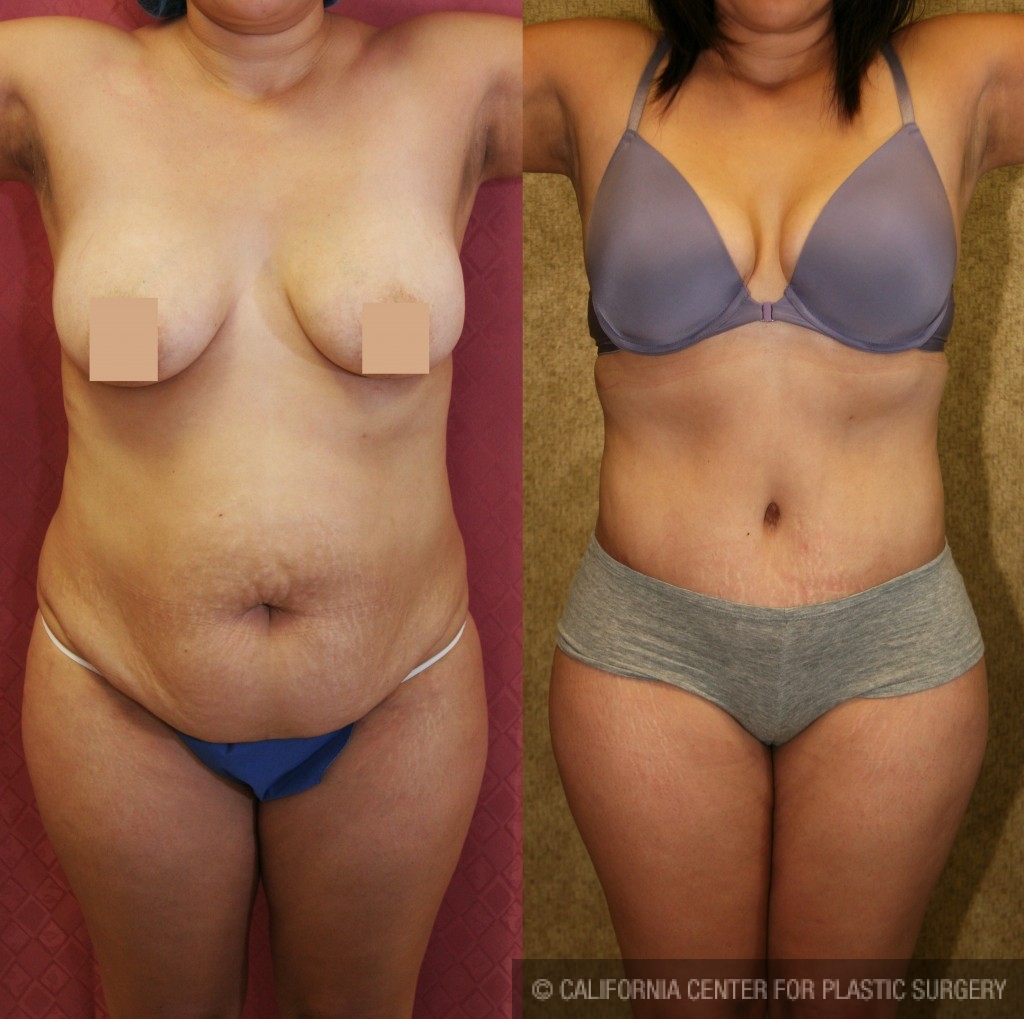 Tummy Tuck Medium Size Before & After Patient #5803