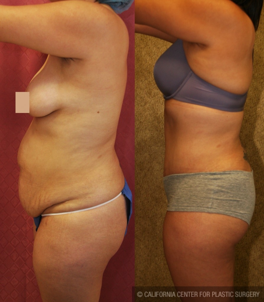Tummy Tuck Medium Size Before & After Patient #5803