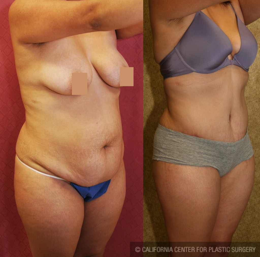 Tummy Tuck Medium Size Before & After Patient #5803