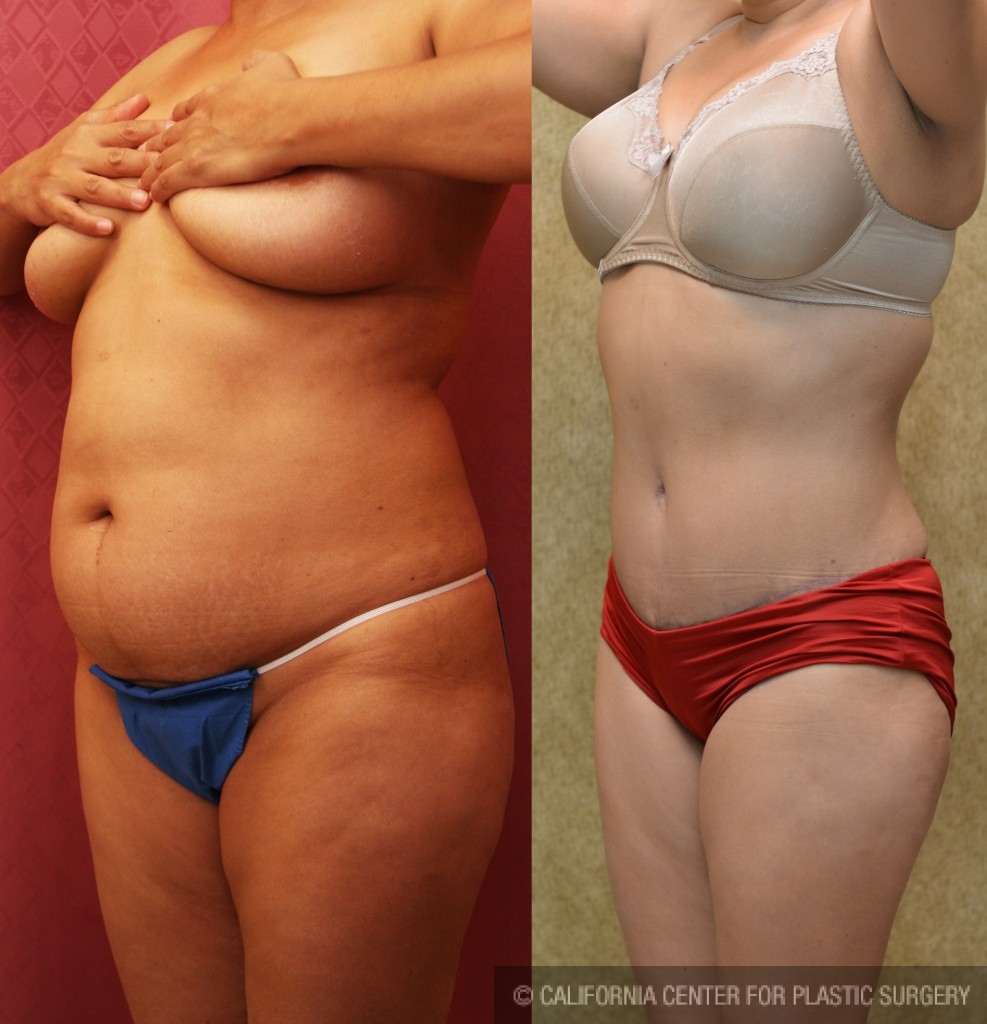 Tummy Tuck (Abdominoplasty) Medium Size Before & After Patient #5808