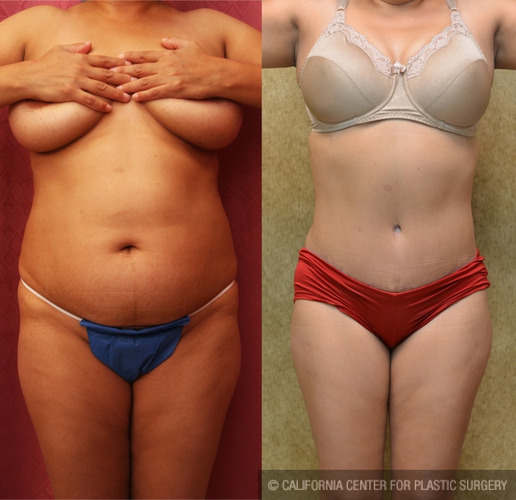 Tummy Tuck (Abdominoplasty) Medium Size Before & After Patient #5808