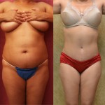 Tummy Tuck (Abdominoplasty) Medium Size Before & After Patient #5808