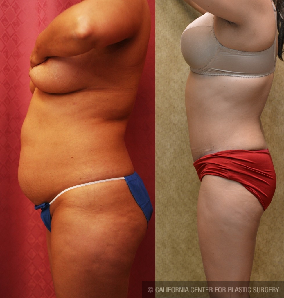 Tummy Tuck (Abdominoplasty) Medium Size Before & After Patient #5808