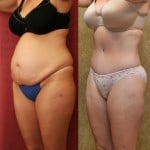 Tummy Tuck (Abdominoplasty) Medium Size Before & After Patient #5865