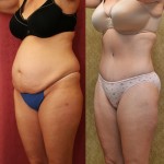 Tummy Tuck (Abdominoplasty) Medium Size Before & After Patient #5865