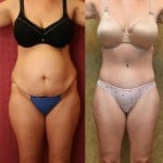 Tummy Tuck (Abdominoplasty) Medium Size Before & After Patient #5865