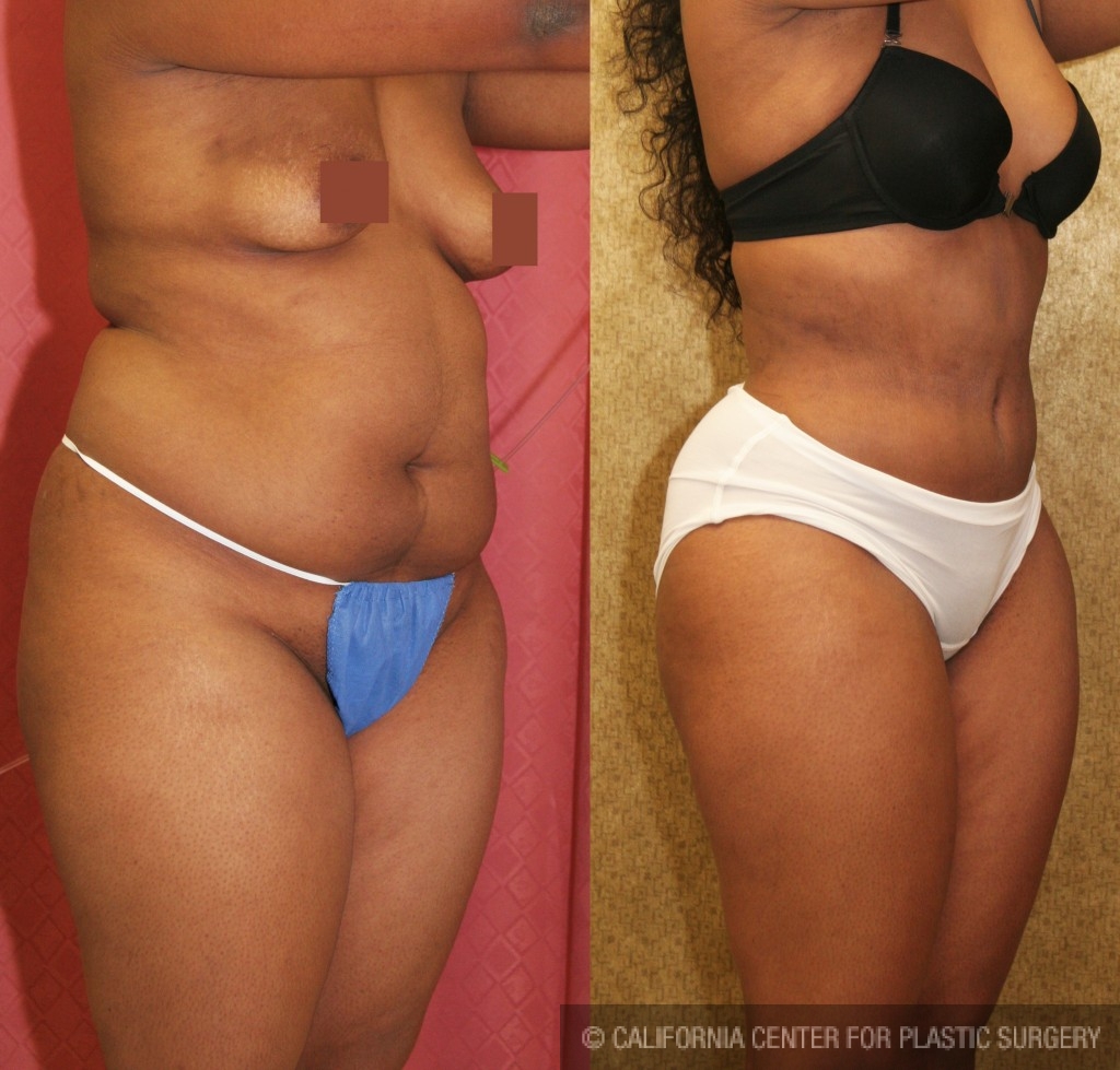 African American Tummy Tuck (Abdominoplasty) Before & After Patient #5953