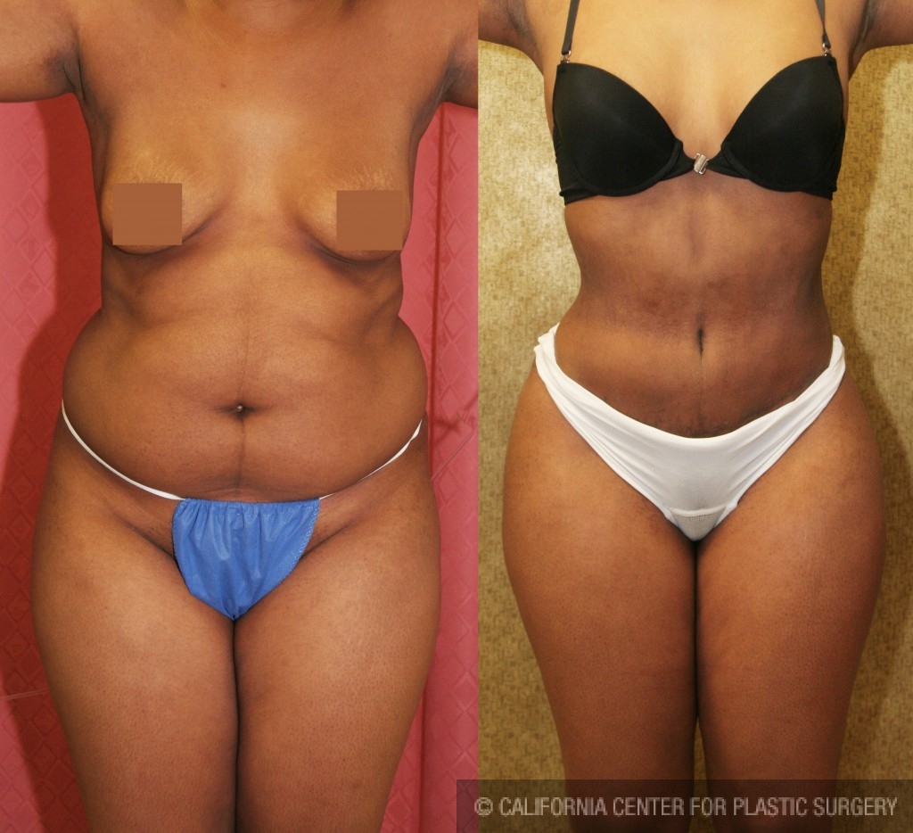 African American Tummy Tuck (Abdominoplasty) Before & After Patient #5953