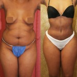 African American Tummy Tuck (Abdominoplasty) Before & After Patient #5953