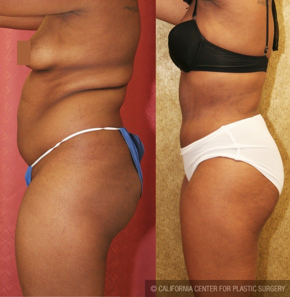 African American Tummy Tuck (Abdominoplasty) Before & After Patient #5953
