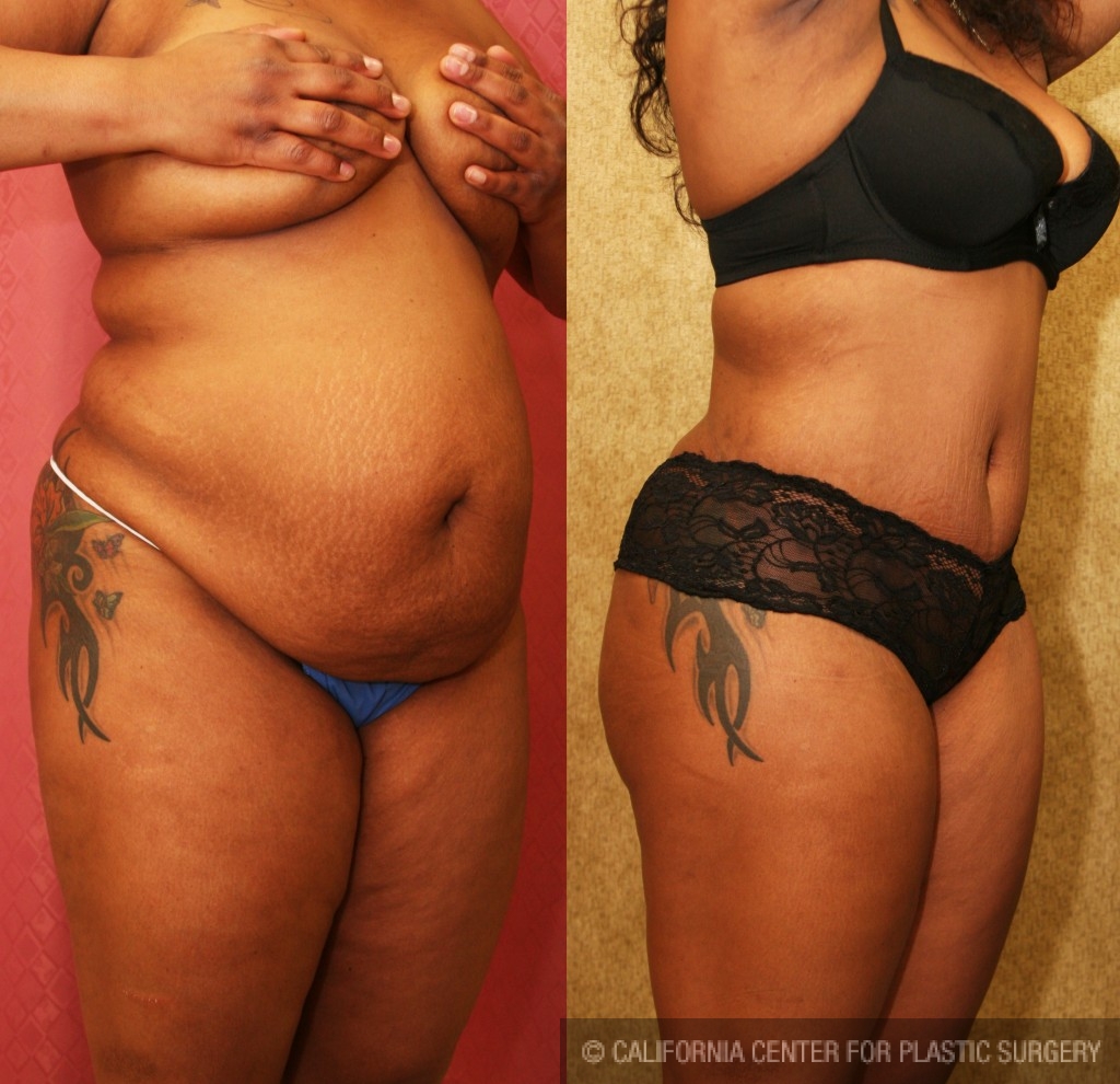 African American Tummy Tuck Before & After Patient #5929