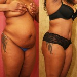 African American Tummy Tuck (Abdominoplasty) Before & After Patient #5929