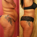 African American Tummy Tuck (Abdominoplasty) Before & After Patient #5929