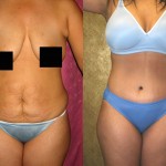 Tummy Tuck (Abdominoplasty) Small Size Before & After Patient #5990