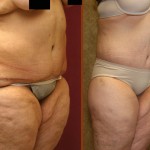 Body Lift Before & After Patient #6047