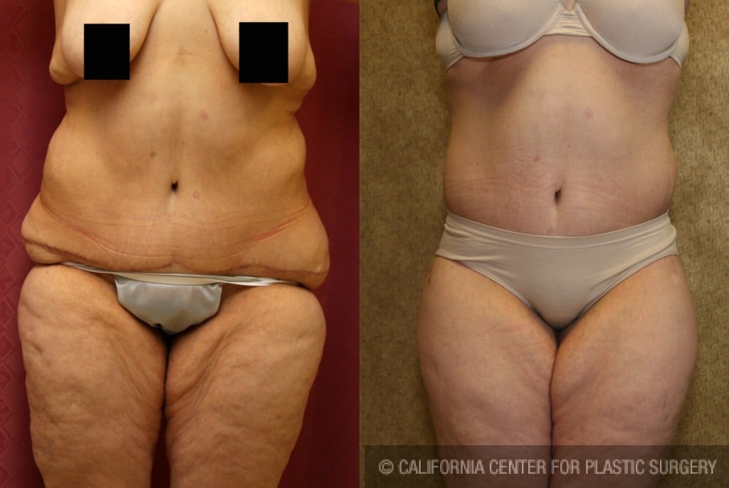 Body Lift Before & After Patient #6047