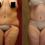 Body Lift Before & After Patient #6047