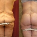 Body Lift Before & After Patient #6047