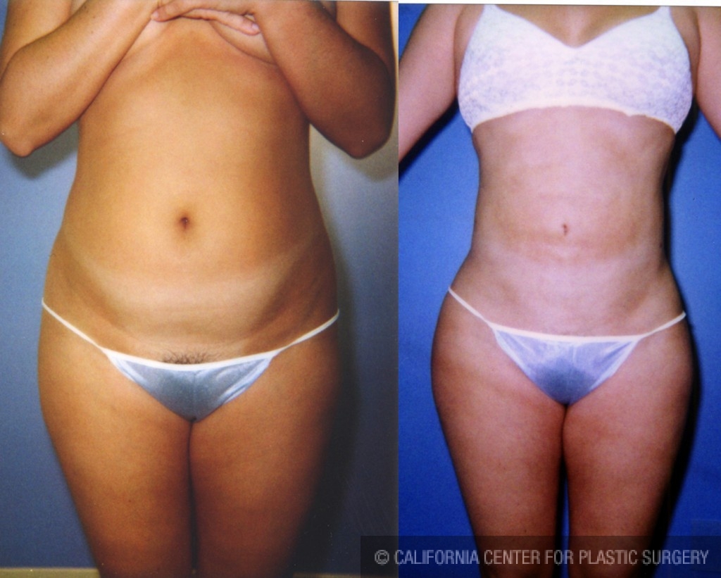 Liposuction Abdomen Medium Before & After Patient #5541
