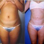 Liposuction Abdomen Medium Before & After Patient #5541