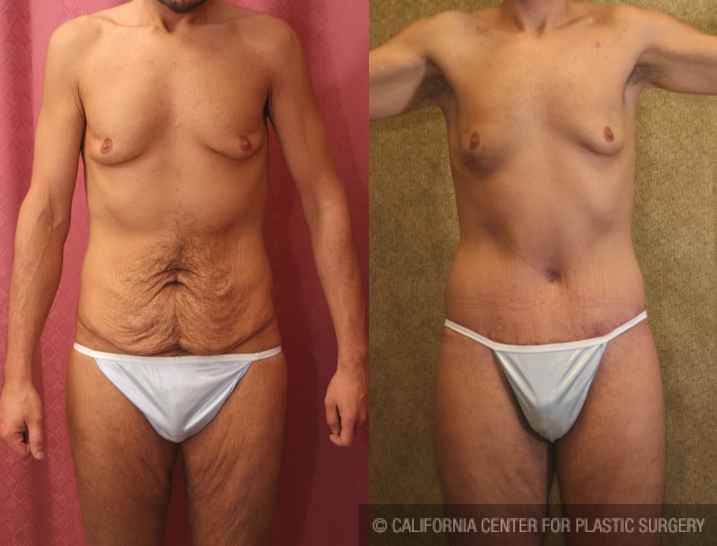 Male Tummy Tuck (abdominoplasty) Before & After Patient #6019
