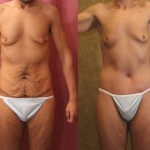 Male Tummy Tuck (abdominoplasty) Before & After Patient #6019