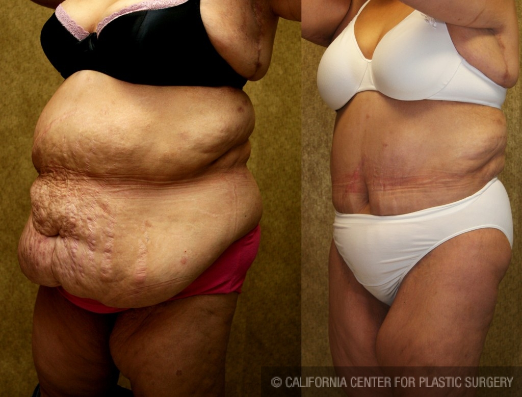 Tummy Tuck (Abdominoplasty) Plus Size Before & After Patient #5898