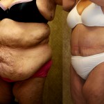 Tummy Tuck (Abdominoplasty) Plus Size Before & After Patient #5898