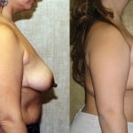 Breast Lift - Full Before & After Patient #6937