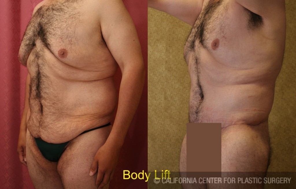 Patient #6023 Male Tummy Tuck (abdominoplasty) Before and After