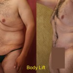 Male Tummy Tuck (abdominoplasty) Before & After Patient #6023