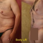 Body Lift Before & After Patient #6041
