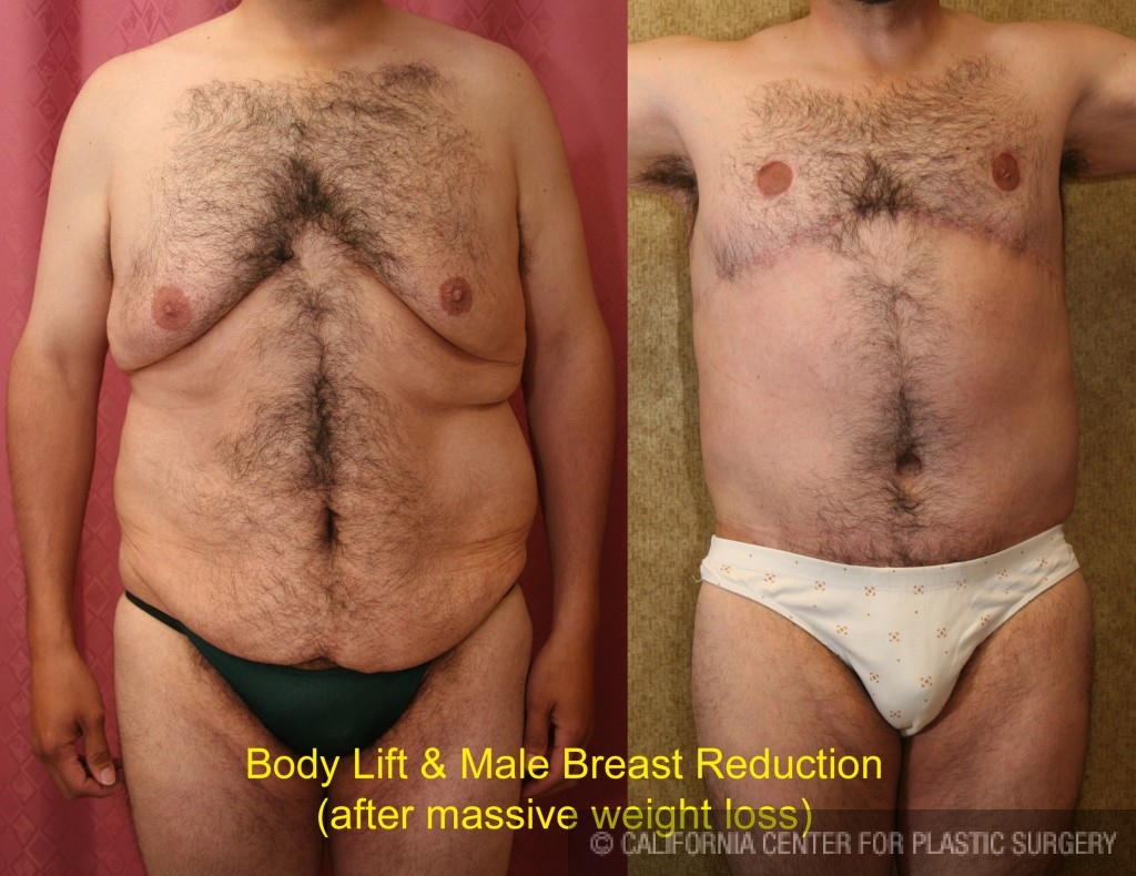 Body Lift Before & After Patient #6041